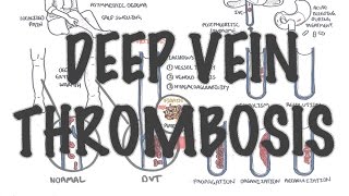 Deep Vein Thrombosis  Overview pathophysiology treatment complications [upl. by Mariejeanne]