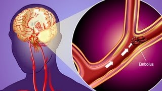 Stroke Prevention amp Transient Ischemic Attack TIA [upl. by Ybor489]