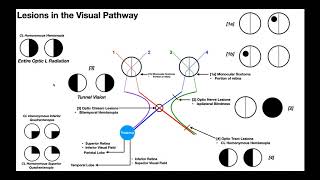 Lesions to the Visual Pathway EXPLAINED [upl. by Coral]